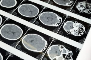 Trombose venosa cerebral e seus efeitos em jovens
