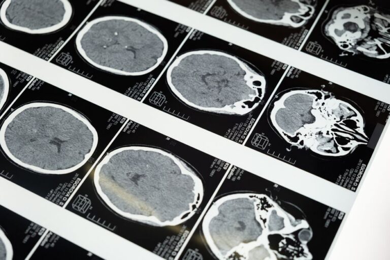 Trombose venosa cerebral e seus efeitos em jovens