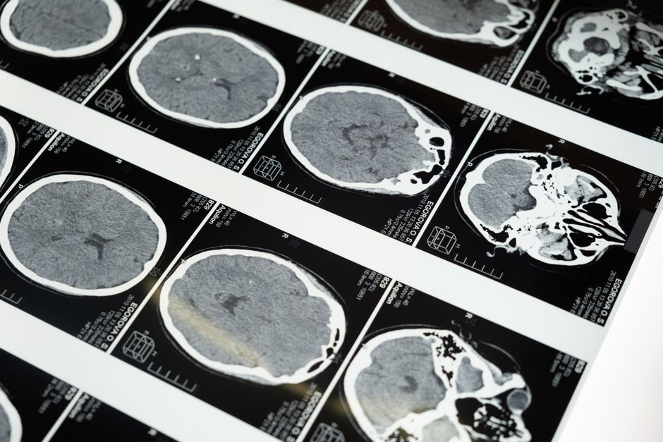 Trombose venosa cerebral e seus efeitos em jovens